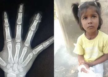 कर्नाटक के सरकारी विद्यालय में छह बर्षीय बच्ची की दो उंगलियां कटीं, माता-पिता ने कर्मचारियों पर लगाया लापरवाही का आरोप