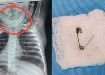 नवजात के गले में अटकी खुली हुई सेफ्टी पिन, तस्वीर देख कांप उठेगा कलेजा, जानें फिर क्या हुआ?