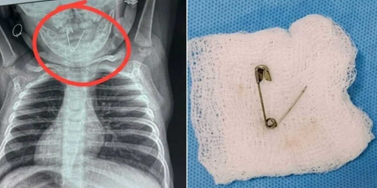 नवजात के गले में अटकी खुली हुई सेफ्टी पिन, तस्वीर देख कांप उठेगा कलेजा, जानें फिर क्या हुआ?