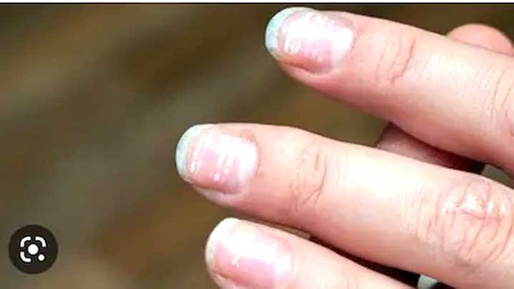 पीले, कमजोर या सफेद दाग वाले नाखून? शरीर दे रहा हो सकता है बीमारी का संकेत