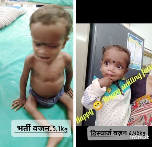 सेवा की कहानी: पोषण पुनर्वास केंद्र ने ओमेश को कुपोषण से उबारा, अब स्वस्थ होकर लौटा घर