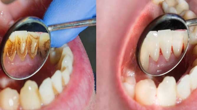 Yellow Teeth: दांतों का पीलापन कम करने के लिए अपनाएं ये आसान टिप्स